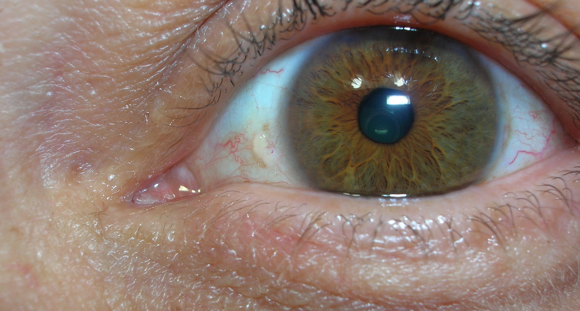 Yellow Fat Deposits In Eyes